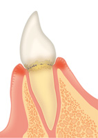 初期歯周病（歯肉炎）